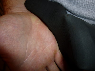 Ratfish sting near thumb/palm and punctured dry glove